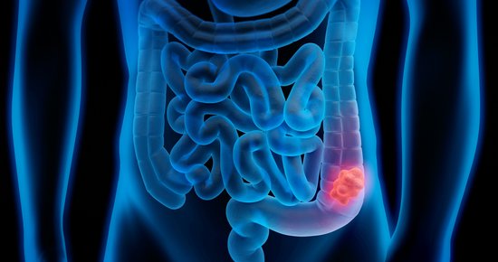 Darmpolyp